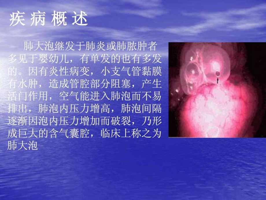 胸腔镜肺大疱切除1587892266.ppt.ppt_第3页