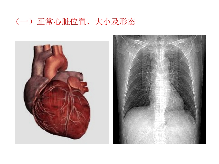 风湿性心脏病心包疾病.ppt_第3页