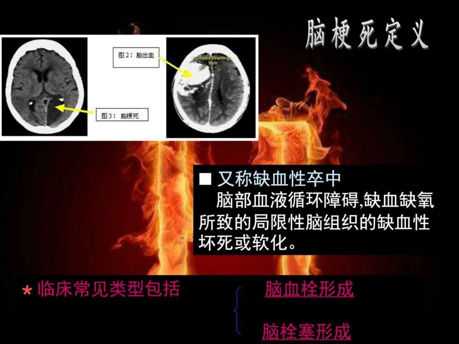 脑梗死PPT图文1509290596.ppt.ppt_第2页