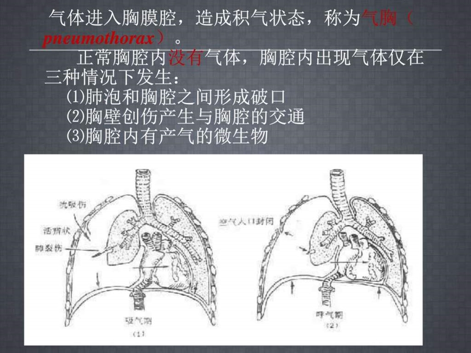 胸腔闭式引流术课件图文1588823435.ppt.ppt_第3页