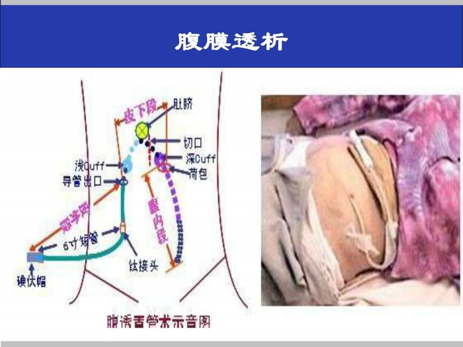 腹膜透析感染诊治2月版2图文.ppt.ppt_第2页