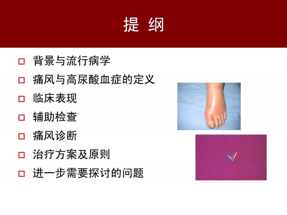 中国痛风临床诊治指南解读1529786302.ppt.ppt_第2页