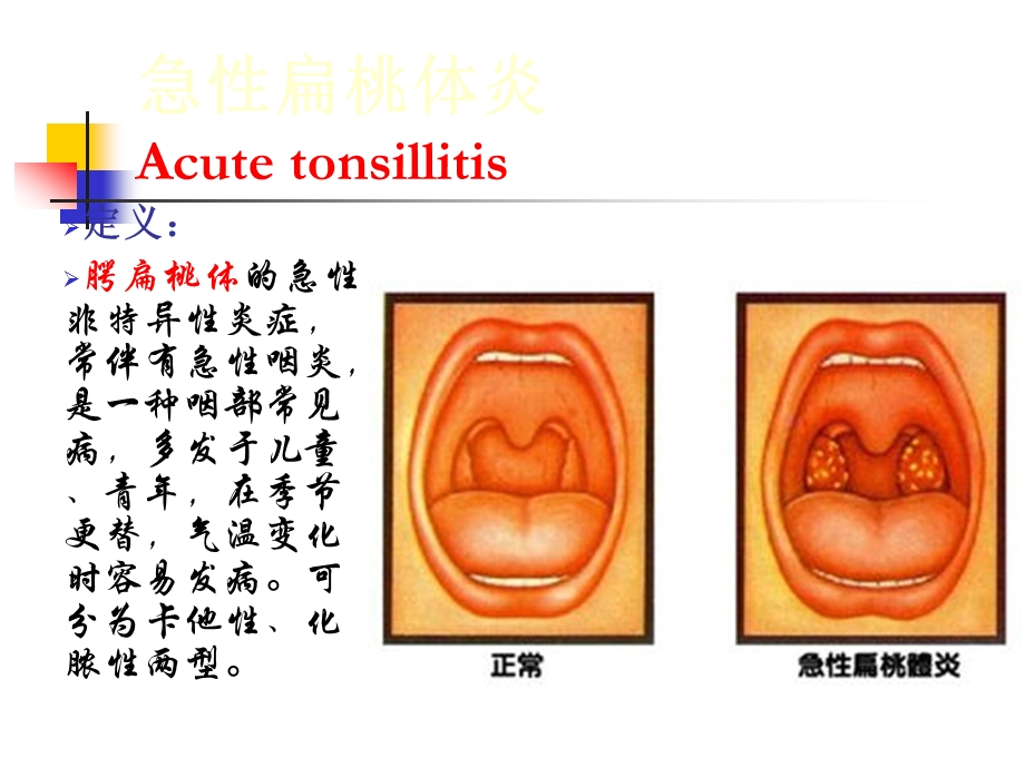 耳鼻咽喉头颈外科学三05扁桃体炎.ppt_第3页