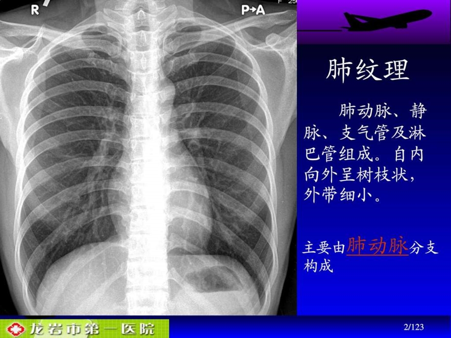 肺动脉栓塞影像诊断1.ppt.ppt_第2页