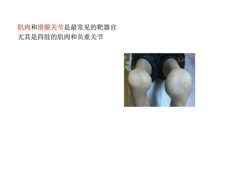 血友病关节炎图文.ppt.ppt_第3页