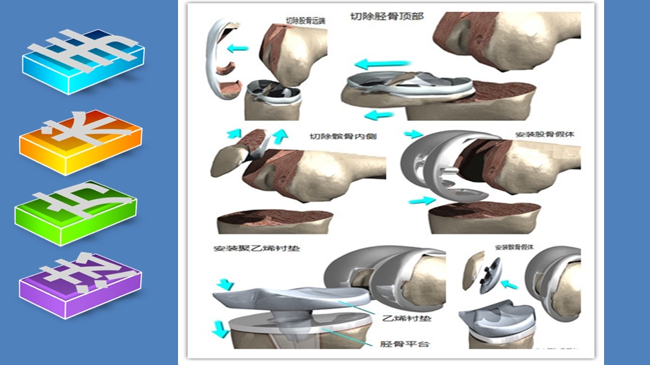 7全膝关节置换术.pptx.ppt_第3页