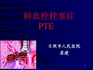 肺栓塞幻灯1205.ppt.ppt