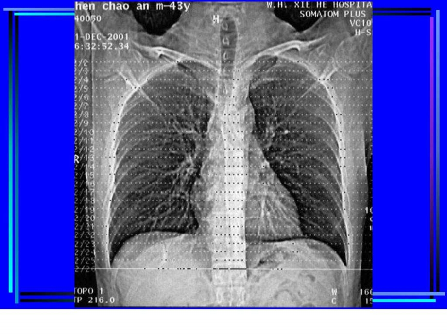 胸部CT诊断大量实例CT片.ppt.ppt_第3页