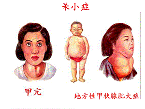 地方性甲状腺肥大症.ppt