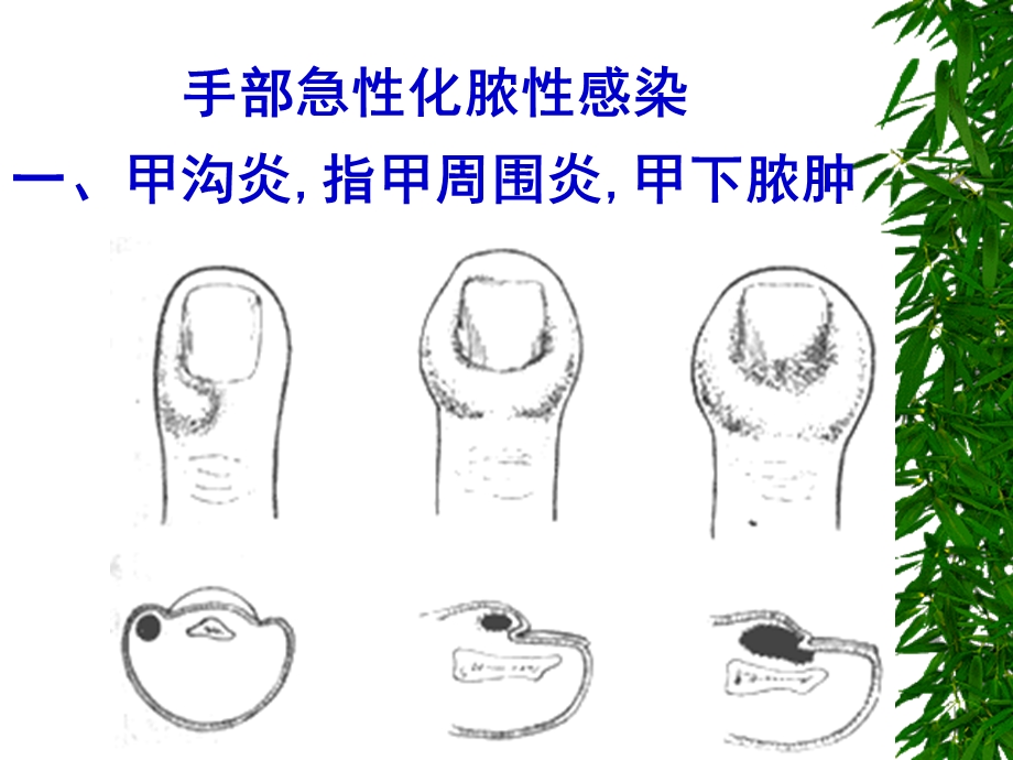 手部急性化脓性感染.ppt_第1页