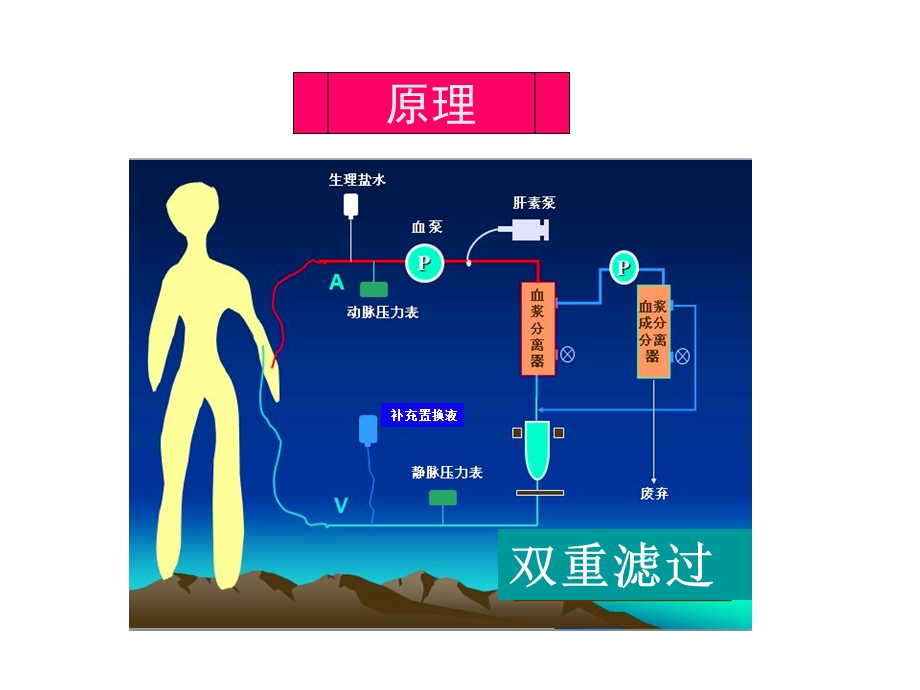 双重滤过血浆置换不良反应及处理.ppt_第2页