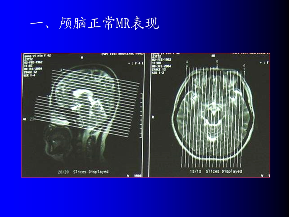 磁共振成像诊断(MRI)脑部疾病.ppt_第3页