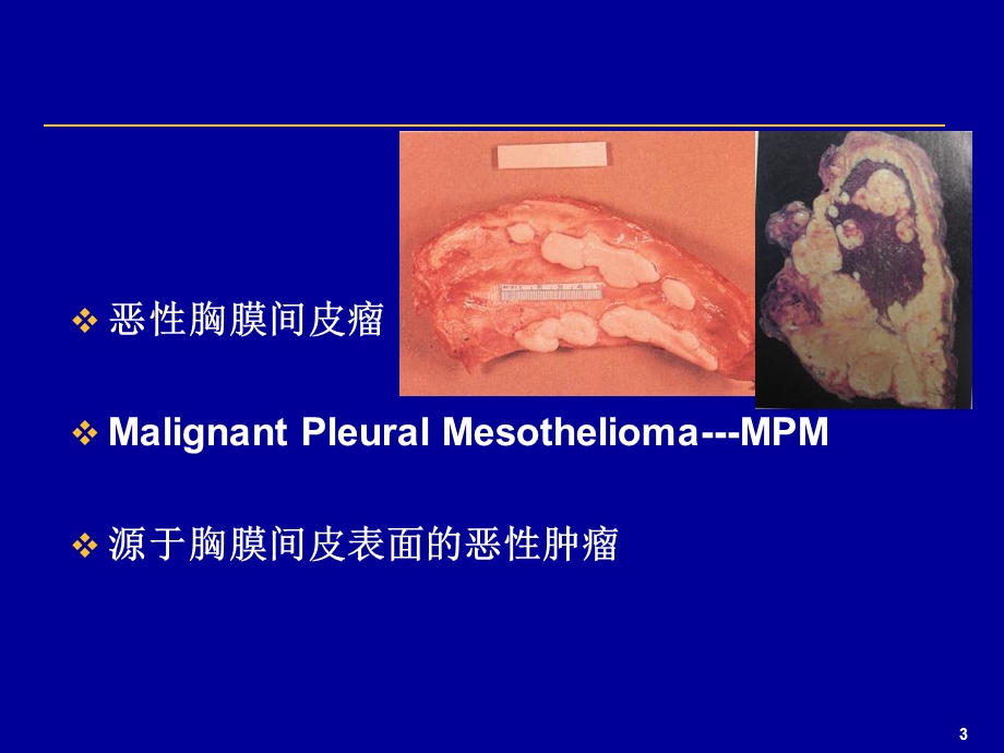 恶性胸膜间皮瘤.ppt_第3页