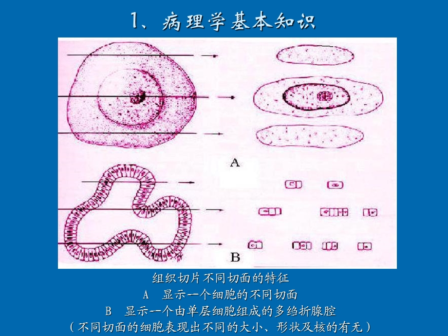 病理学典型病变.ppt_第2页