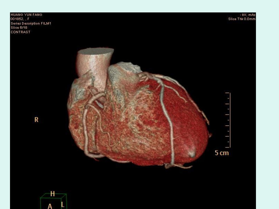 心脏冠状动脉cta成像.ppt_第3页