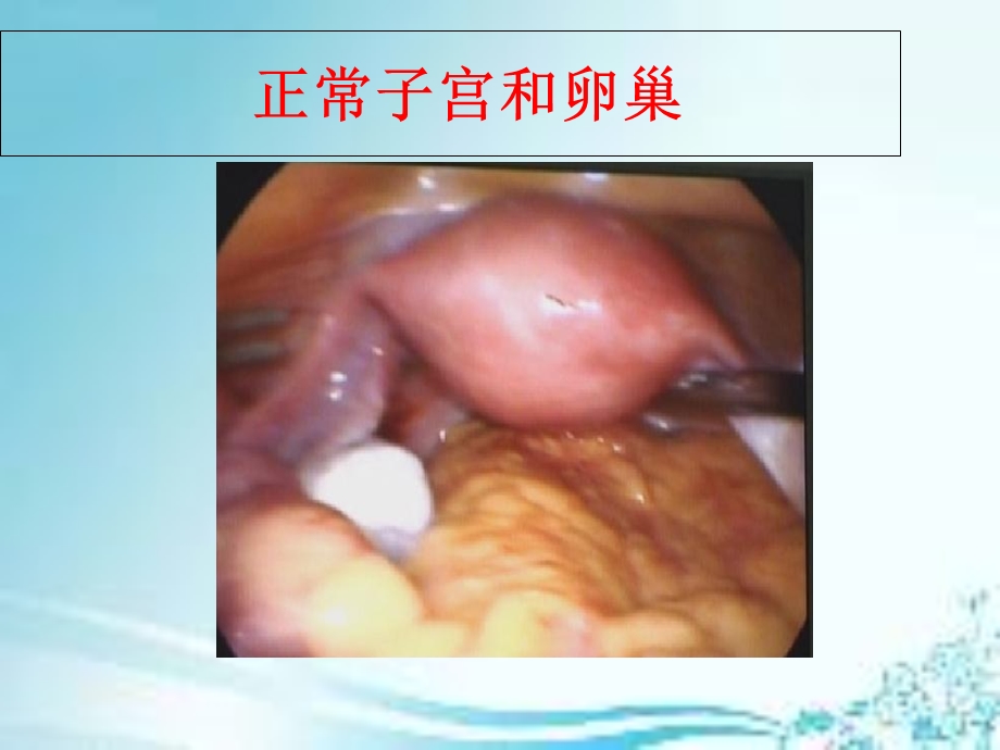 多囊卵巢综合症(PCOS).ppt_第2页