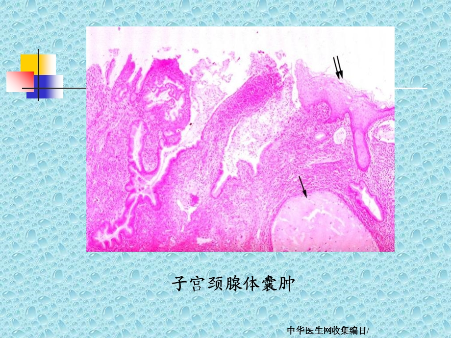 慢性子宫颈炎和宫颈癌.ppt_第3页