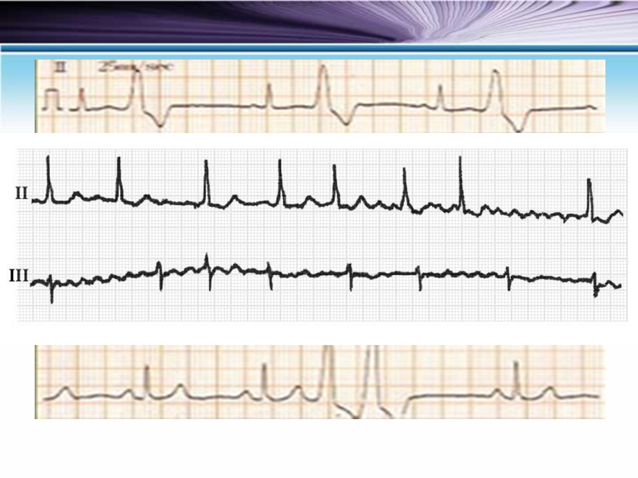 常见心律失常的分析.ppt_第2页