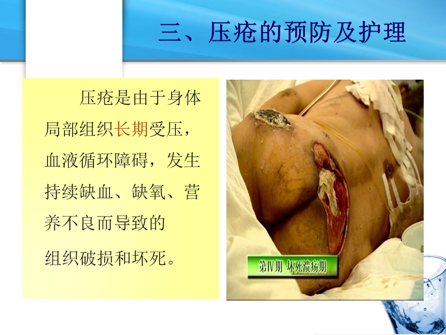 病人清洁的护理压疮.ppt_第2页