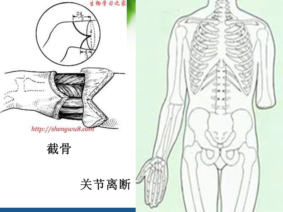 截肢的社区康复.ppt_第3页