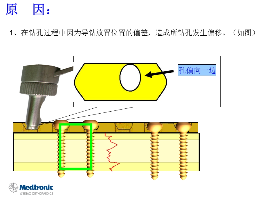 螺钉钢板断裂原因分析.ppt_第3页