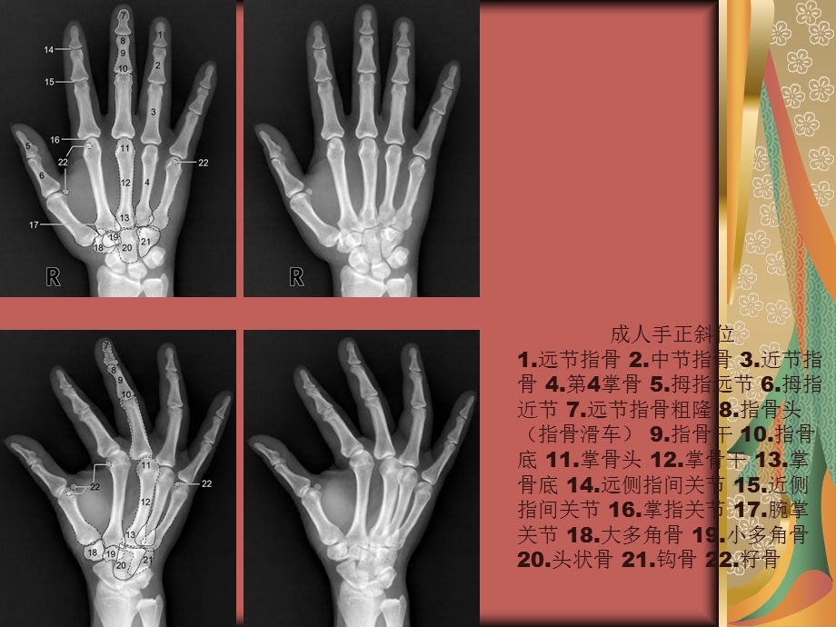 四肢关节正常变异、常见病变及创伤的影像表现.ppt_第3页