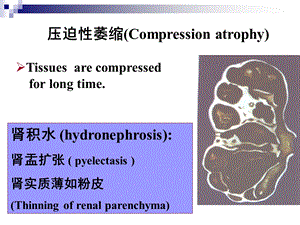 压迫性萎缩(Compression atrophy).ppt