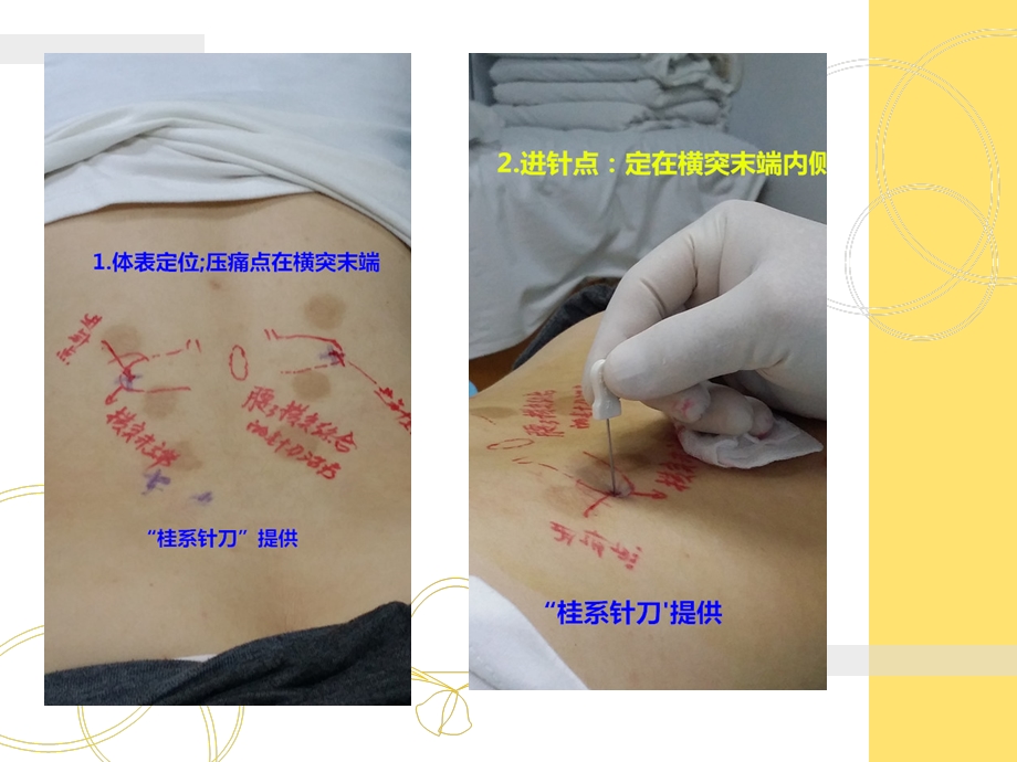 周学龙-针刀松解术治疗腰3横突综合症的步骤和方法.ppt_第3页