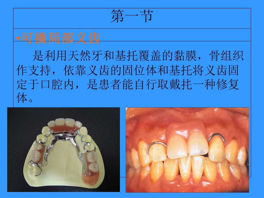 可摘局部义齿修复工艺.ppt_第2页