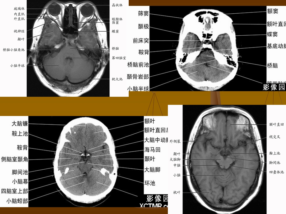 影像诊断学实习 中枢神经系统实习.ppt_第3页
