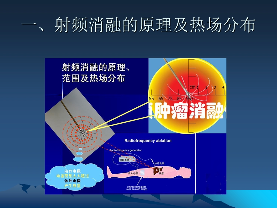 射频消融术的重大技术突破一AgreatbreakthroughonRFA.ppt_第2页