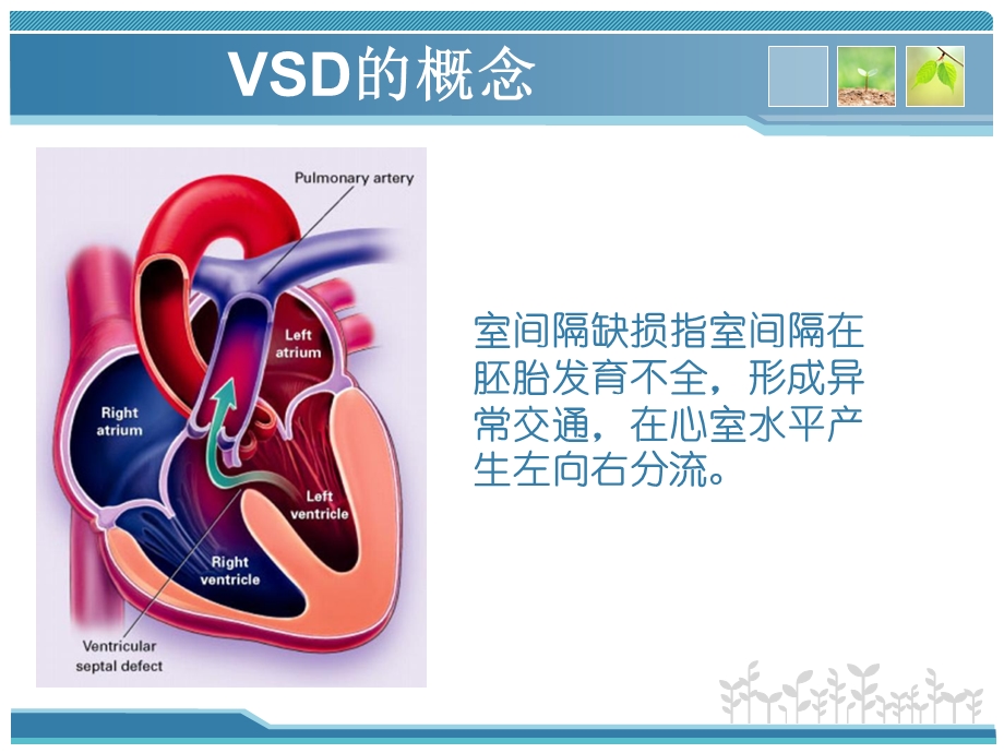 室间隔缺损修补术.ppt_第3页