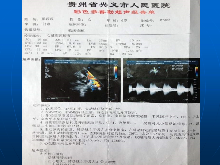 巨大PDA介入治疗回顾.ppt_第3页