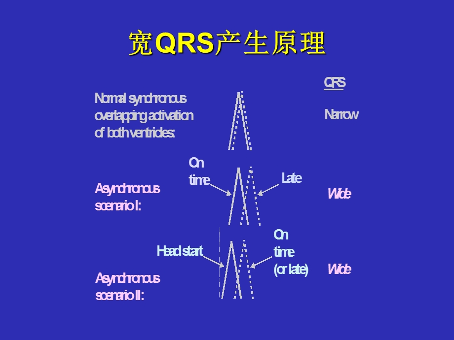 宽QRS波心动过速鉴别诊断.ppt_第3页