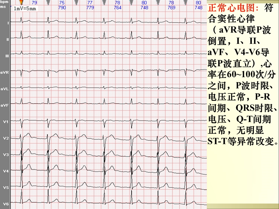 图解常见心电图诊断.ppt_第3页