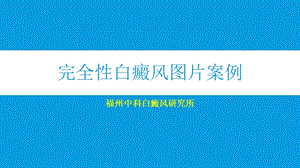 完全性白癜风图片案例.ppt