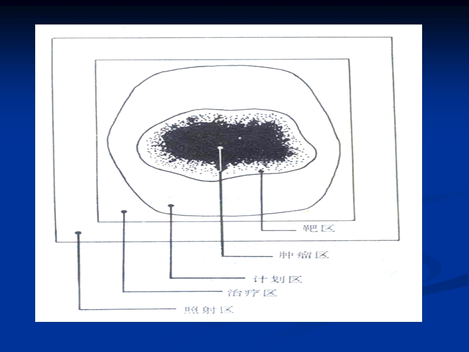 放疗的生物靶区.ppt_第3页