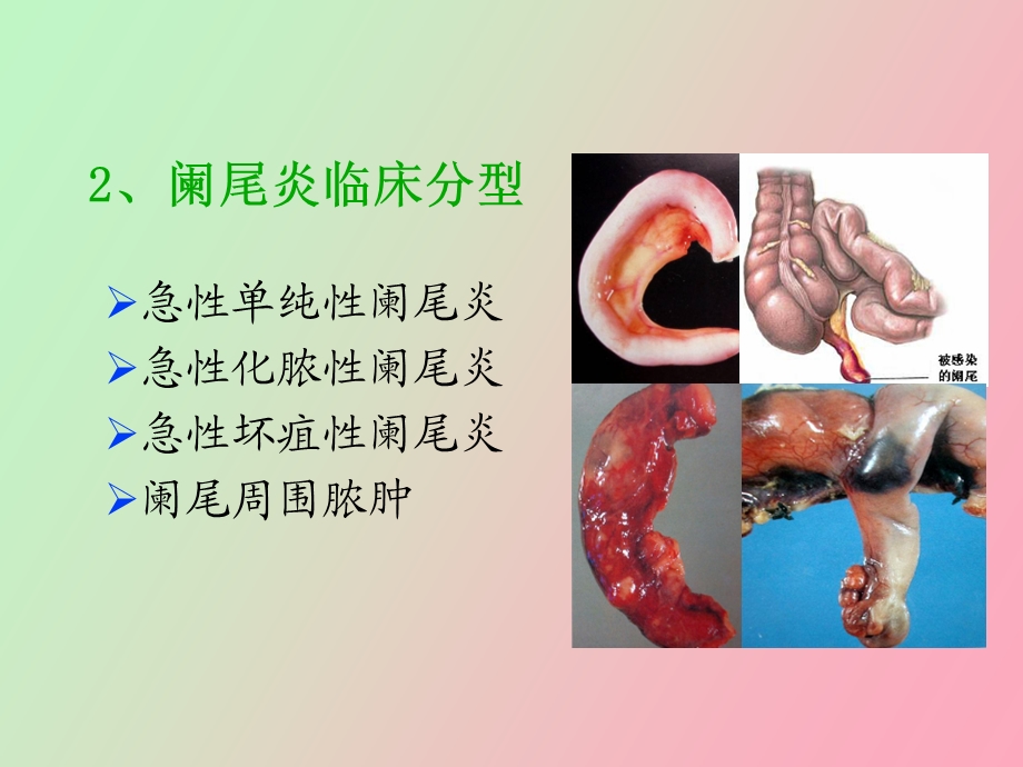 急性阑尾炎实训.ppt_第2页