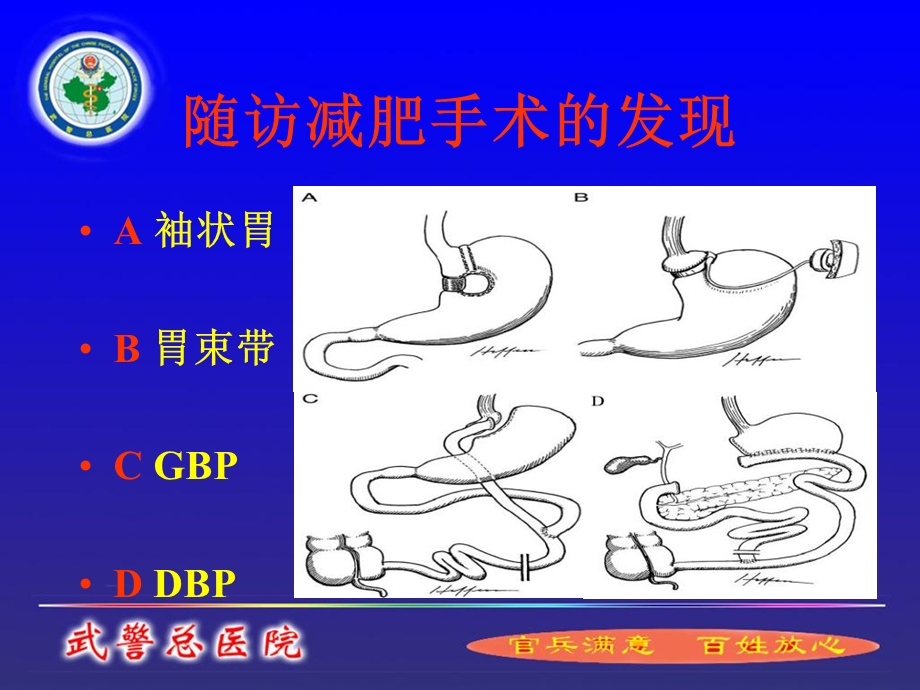 手术治疗糖尿病.ppt_第3页