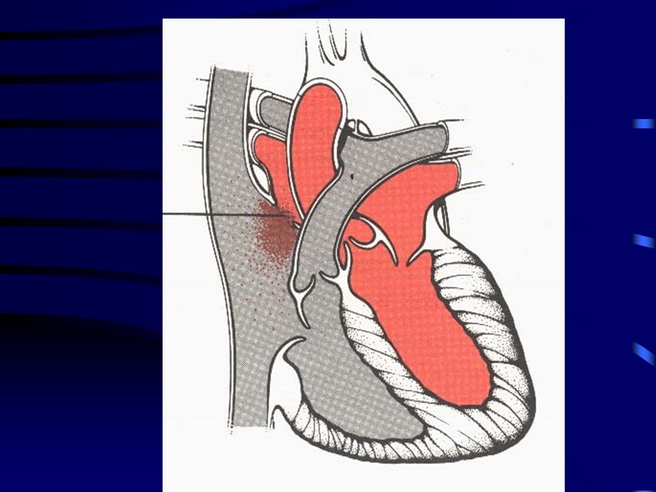 房间隔缺损atrialseptaldefectASD.ppt_第3页