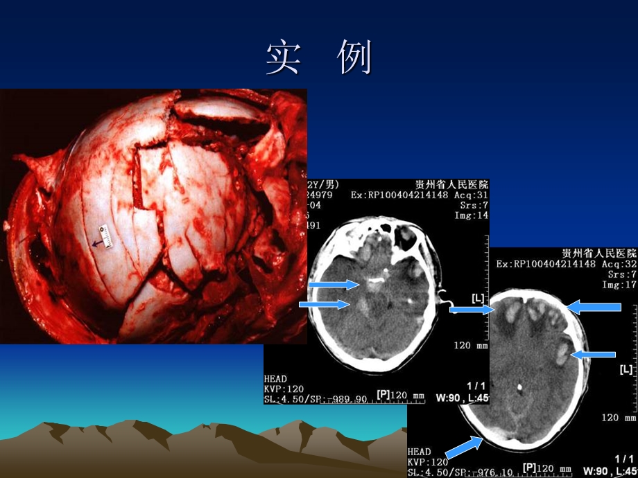 急性特重型颅脑损伤患者护理-最终.ppt_第3页