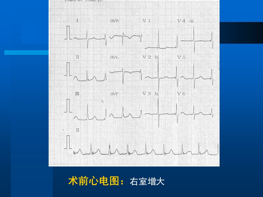 房缺介入封堵一例.ppt_第3页