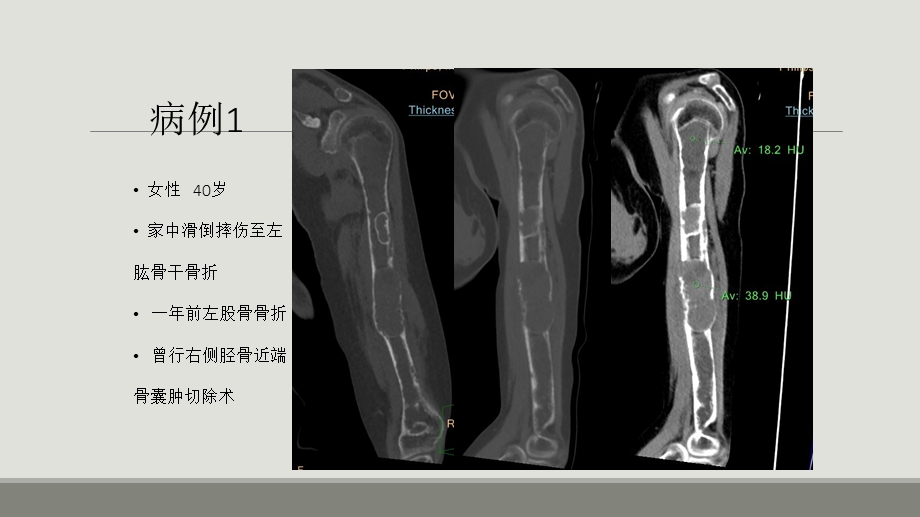 甲状旁腺亢进棕色瘤的影像诊断.ppt_第2页