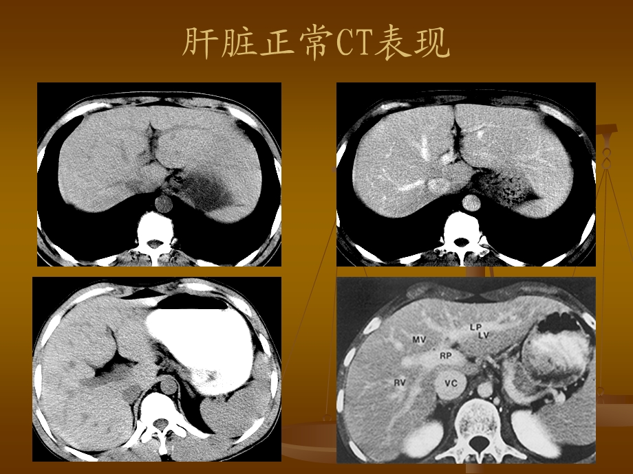 影像诊断学实习 肝胆脾胰疾病实习.ppt_第3页