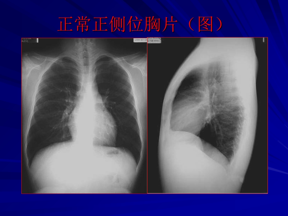 正常正侧位胸片(图.ppt_第1页