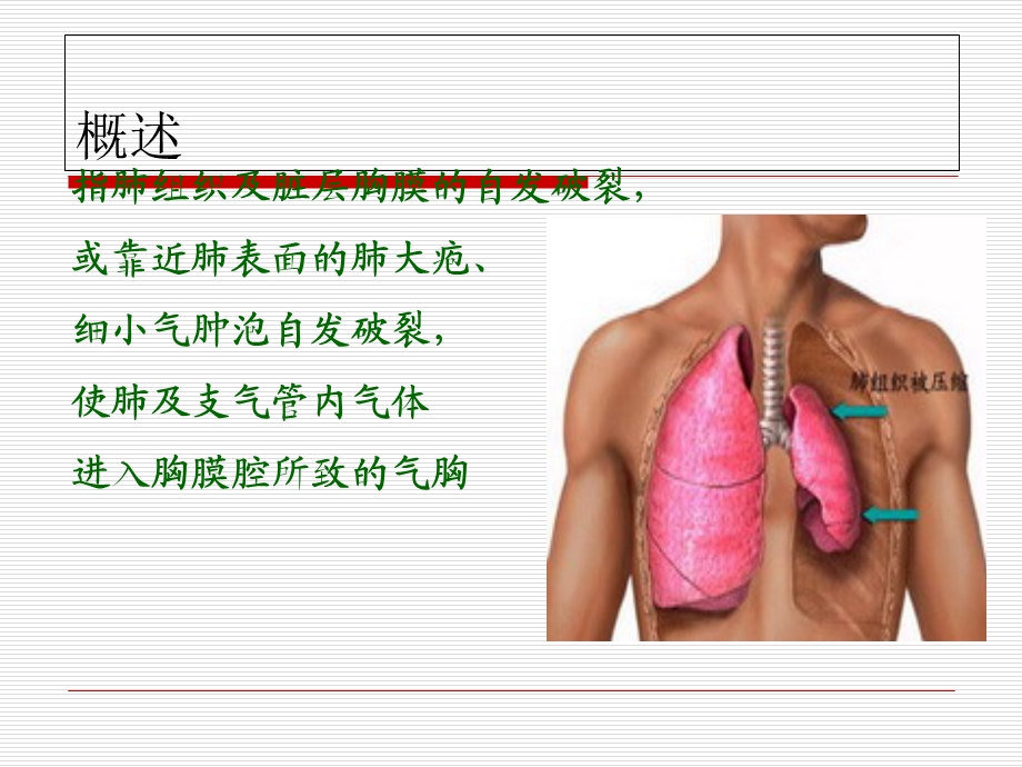 液气胸病人护理查房.ppt_第2页