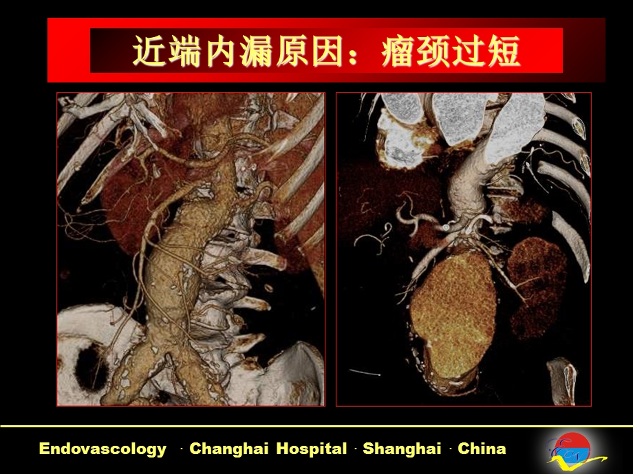 涉及分支动脉的主动脉腔内隔绝移植物系统的研制课件.ppt_第3页