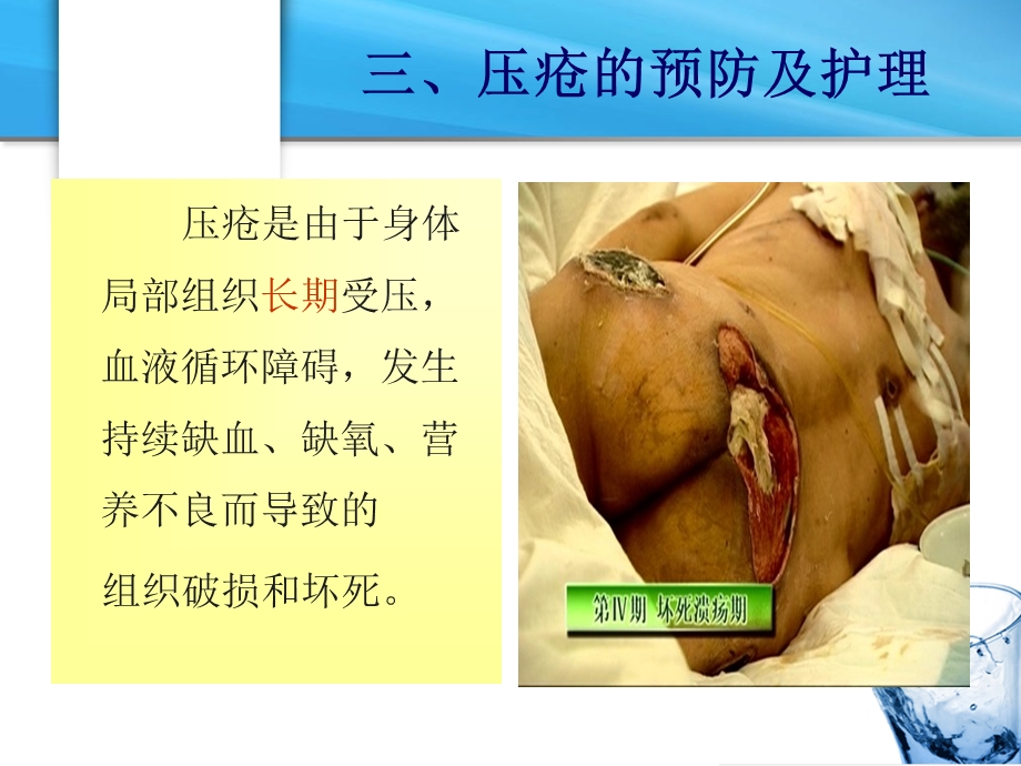 病人清洁的护理压疮 ppt课件.ppt_第2页