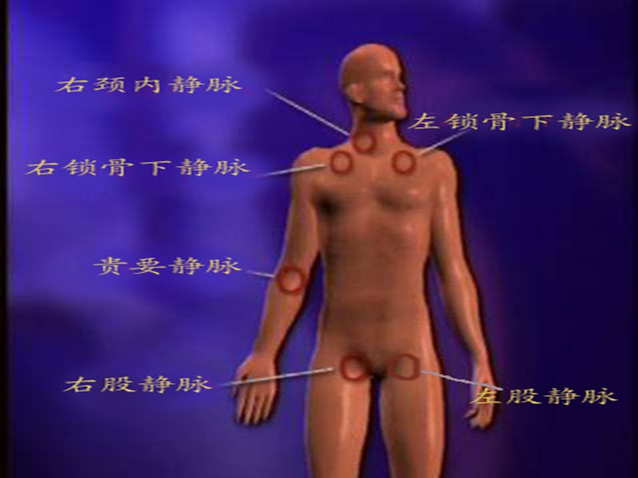 深静脉置管与PICC.ppt_第3页