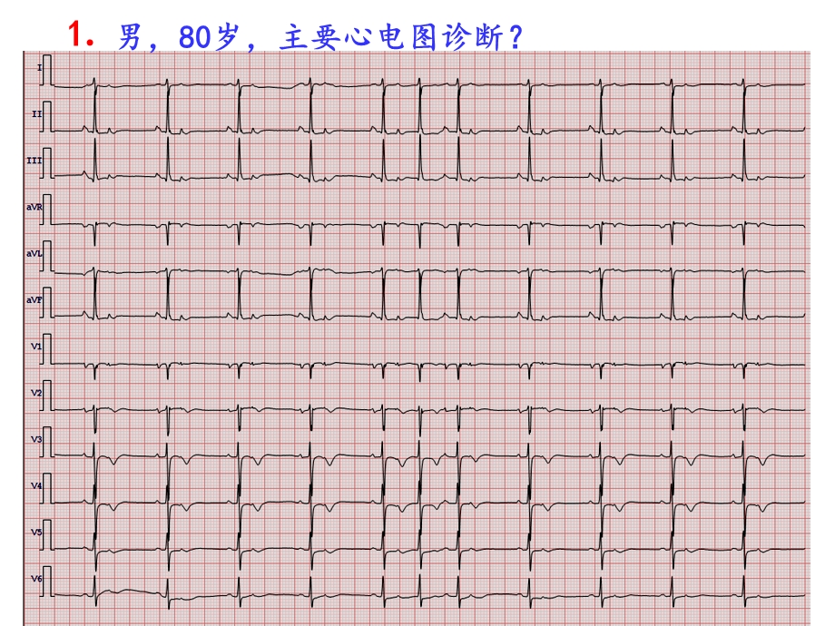 疑难心电图诊断.ppt_第2页